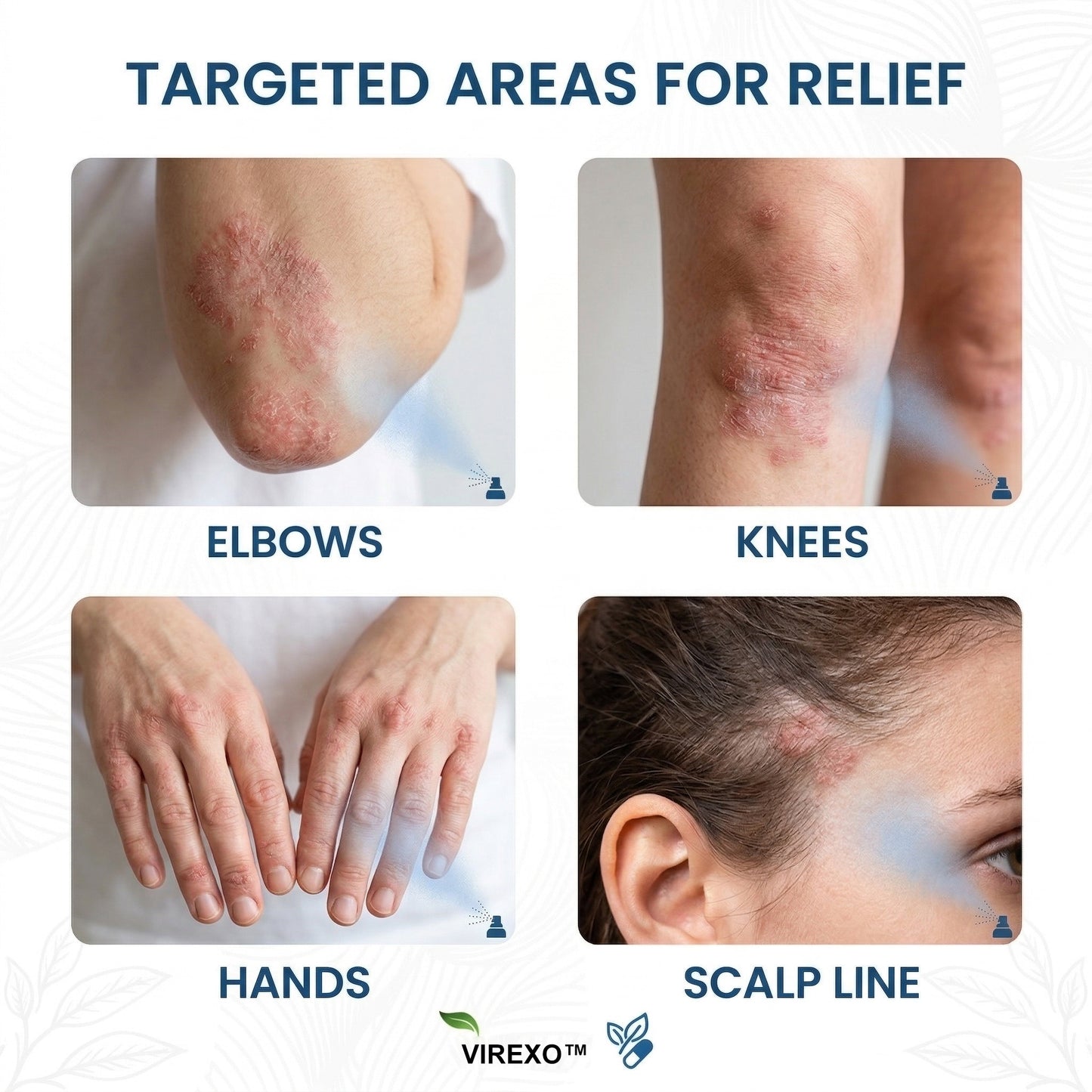 ✅ Official Store | Virexo™ Magnesium Botanical Spray – Advanced Skin Recovery for Psoriasis & Eczema | Rapid Soothing, Steroid-Free
