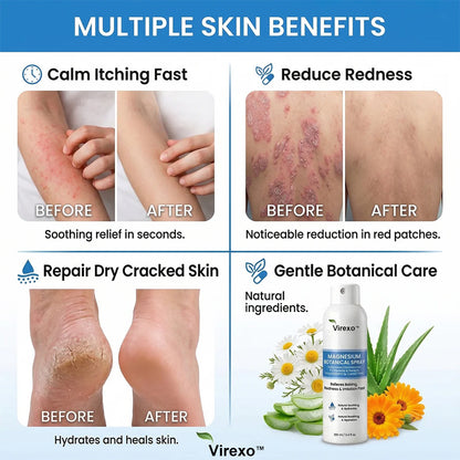 ✅ Official Store | Virexo™ Magnesium Botanical Spray – Advanced Skin Recovery for Psoriasis & Eczema | Rapid Soothing, Steroid-Free